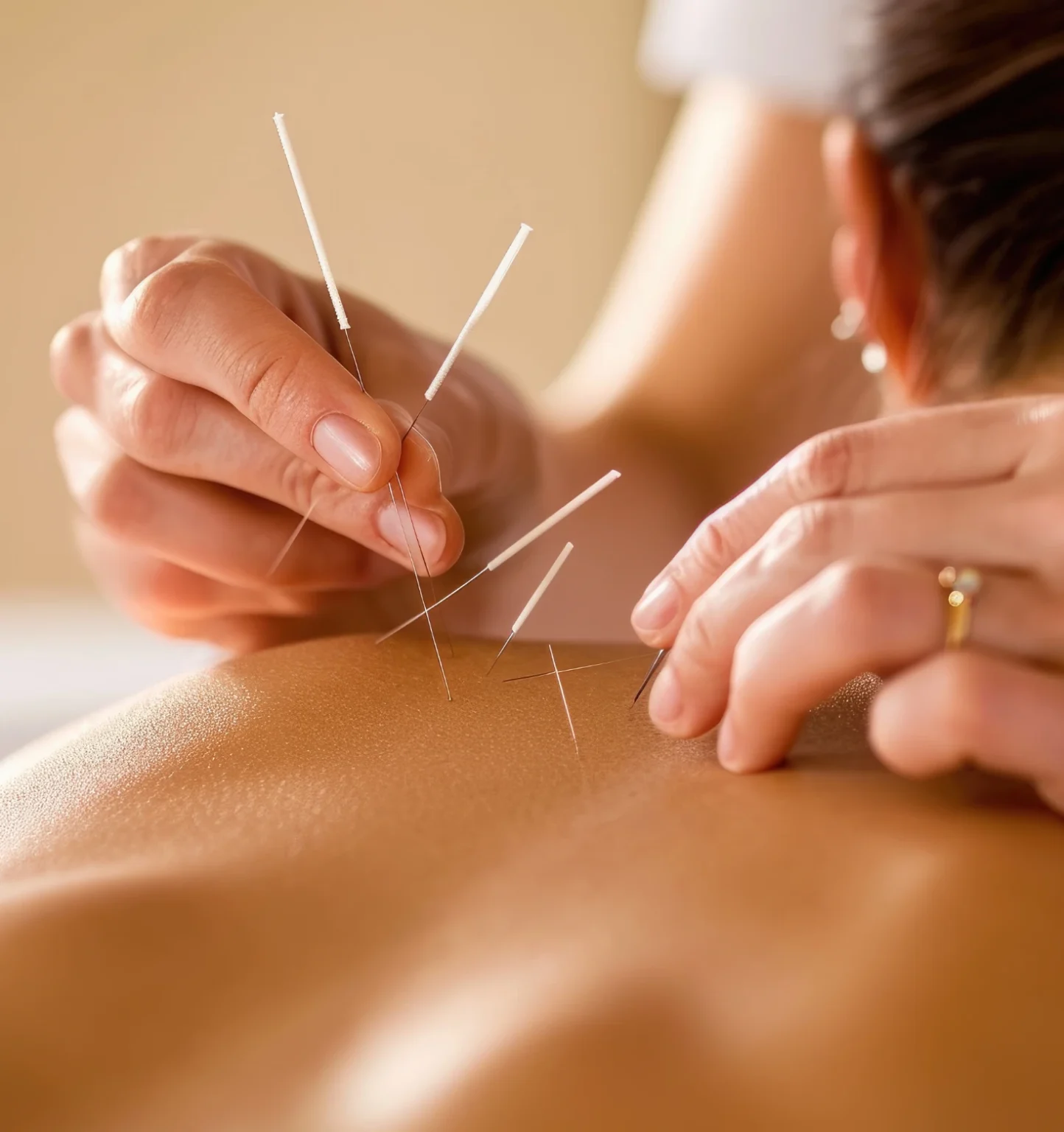 Acupuncture Therapy, needles Therapy