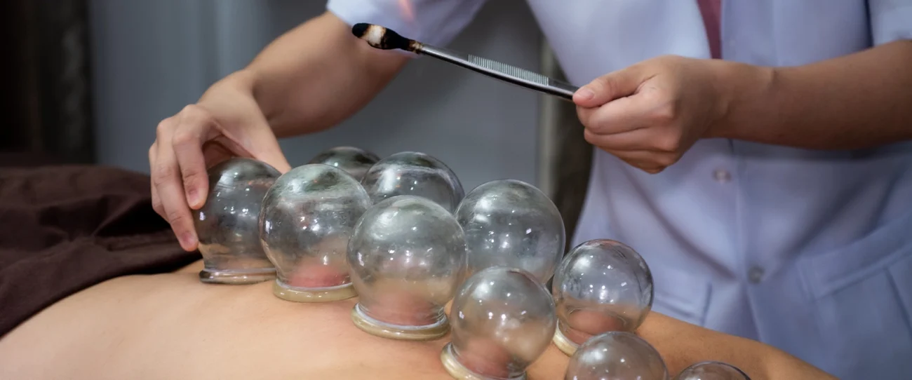 Chinese Medicine Cupping