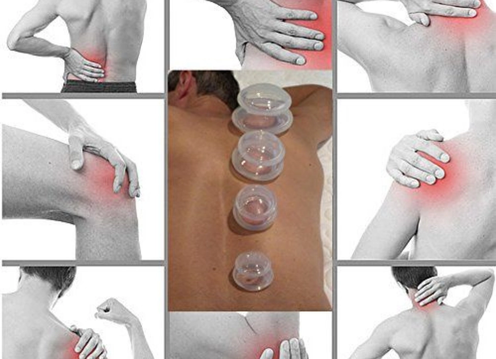 Cupping Therapy in Dubai