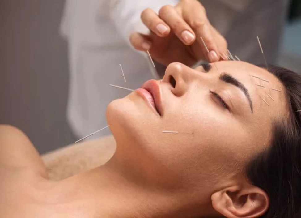 Acupuncture Therapy in dubai