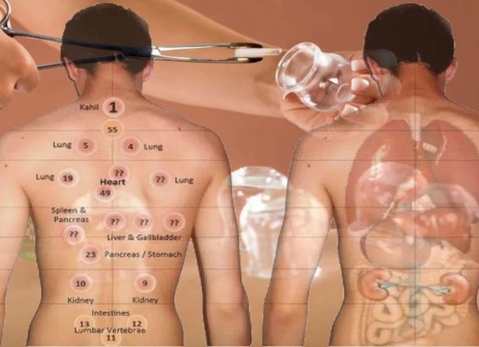 Cupping Therapy in Dubai